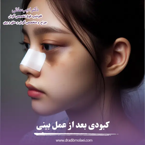 کبودی بعد از عمل بینی _ دکتر ادیب ملائی