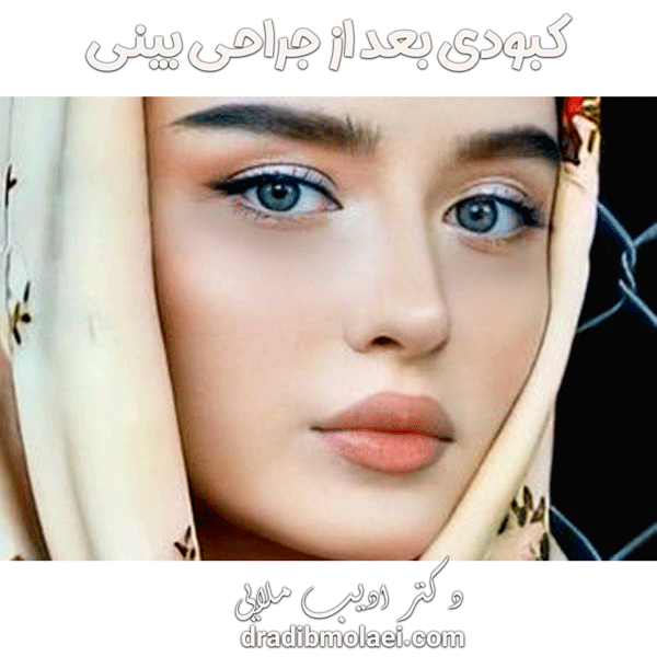 کبودی بعد از جراحی بینی _ دکتر ادیب ملائی