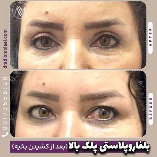 جراحی زیبایی پلک _ دکتر ادیب ملائی