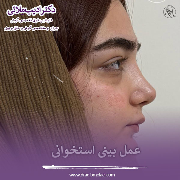 جراحی بینی استخوانی - دکتر ملائی