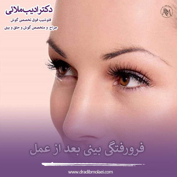 فرورفتگی بینی بعد از عمل - دکتر ادیب ملایی