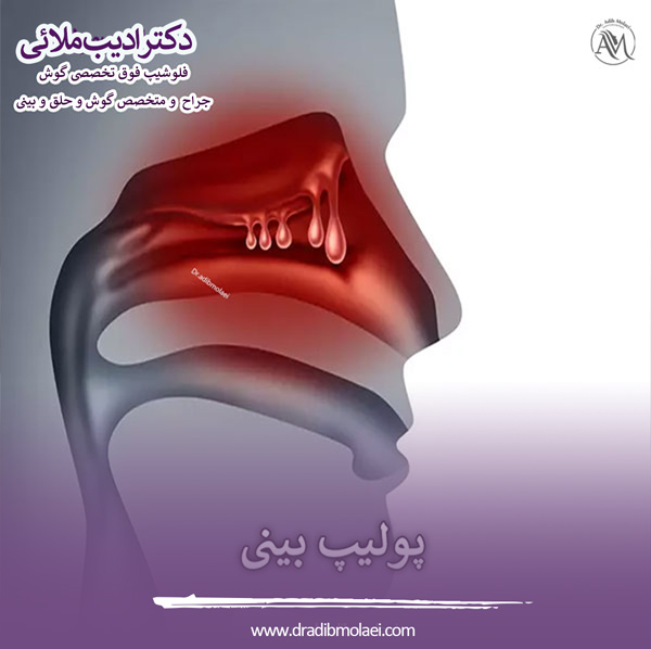 پولیپ بینی - دکتر ملائی