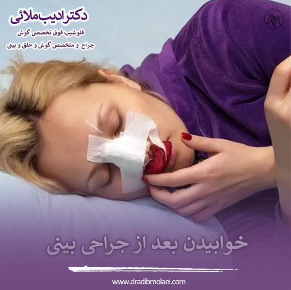 خوابیدن بعد از عمل بینی - دکتر ملائی